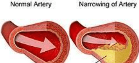 Abnormal Narrowing of an Artery