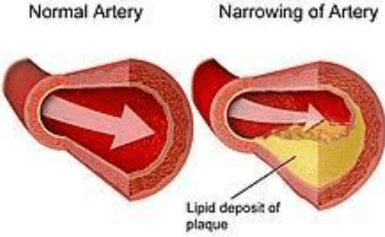 Abnormal Narrowing of an Artery