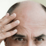 What Are The Causes Of Hair Loss In Men