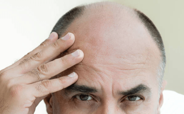 What Are The Causes Of Hair Loss In Men