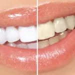 Teeth whitening before and after