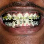 Senior Orthodontics