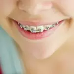 Orthodontic Treatment