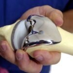 Knee replacement surgery cost